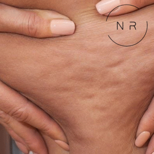 Tratamiento anticelulítico zona localizado.